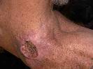 Stem Cells, Cancer, and You